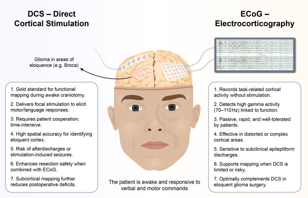 Direct Cortical Stimulation vs. Electrocorticography: Mapping Eloquent Cortex in Glioma&nbsp;Surgery