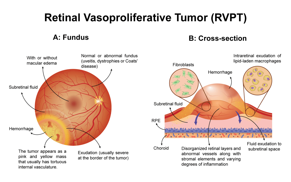 Retinal Vasoproliferative Tumor (RVPT): Fundus and&nbsp;Cross-Section