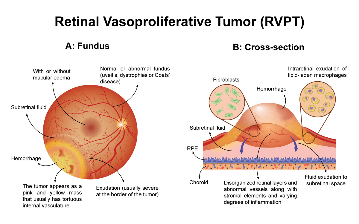 Retinal Vasoproliferative Tumor (RVPT): Fundus and&nbsp;Cross-Section