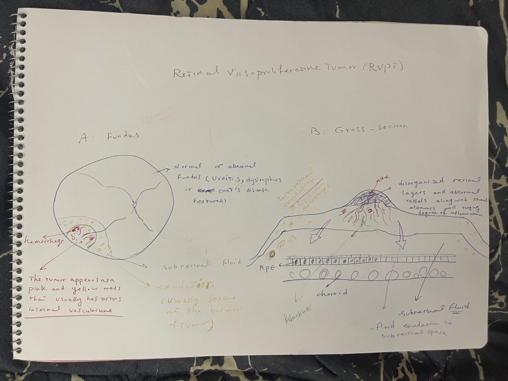 Hand-drawn sketch of a retinal vasoproliferative tumor showing a fundus view and a cross-section of the retina